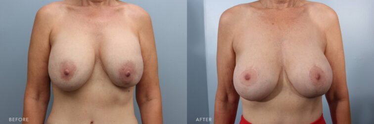 A photo of a woman's body before and after the Bilateral Breast Implant Removal, Bilateral Capsulectomies, Bilateral Breast Implant Exchange, and Mastopexy procedure. The before photo shows heavy and sagging breasts, with her nipples positioned low and pointing downward, giving an elongated shape. The after photo shows uplifted and youthful breasts, with her nipples positioned higher and facing forward, creating a rounder and more balanced shape. | Albany, Latham, Saratoga NY, Plastic Surgery