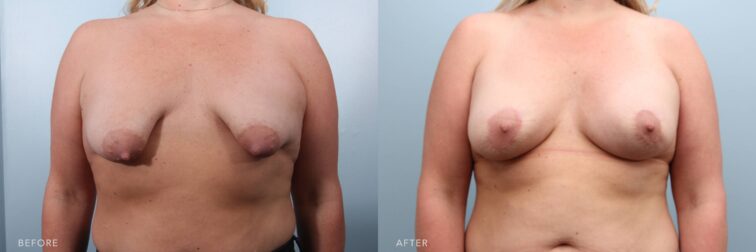 A photo of a woman's body before and after the Bilateral Aug with Lift, Correction of Tuberous Breast Deformity & Abdominal Scar Revision procedure. The before photo shows a tuberous deformity on her breast with significant drooping and downward projection. The after photo shows rounded, lifted breasts with balanced fullness and forward projection, creating a natural and youthful contour. | Albany, Latham, Saratoga NY, Plastic Surgery