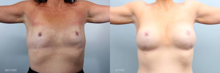 A photo of a woman's body before and after the Bilateral Breast Aug w/ Implants, Lipo Chest Wall procedure. The before photo shows a flat chest with minimal projection, showing signs of previous scarring and lack of breast volume, leaving the upper body without natural contour or fullness. The after photo shows full and projected, with smooth skin and no visible scarring. The breasts show natural volume and contour, giving the upper body a balanced and youthful fullness. | Albany, Latham, Saratoga NY, Plastic Surgery