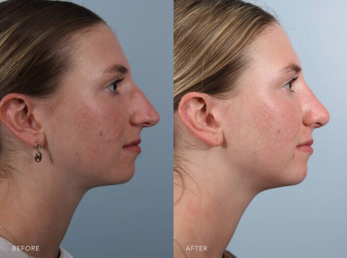 A side-by-side view of a woman's face before and after the Open Cosmetic Rhinoplasty procedure. The before photo shows a nose that looks wider through the middle, with a subtle hump along the bridge. The transition from brow to tip is less even, giving the profile a less streamlined look. The after photo shows a nose that is slender and well-proportioned. The bridge is straight, and the overall shape appears smooth and harmonious with the other features. | Albany, Latham, Saratoga NY, Plastic Surgery