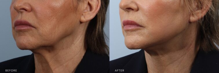 A side-by-side view of a woman's face before and after the Deep Plane Facelift and TCA Peel procedure. The before photo shows a jawline that appears less defined, as sagging soft tissue contributes to the early formation of jowls. The neck shows looseness with faint vertical bands and fine crepe-like wrinkling. The after photo shows a sharply defined jawline with no visible sagging or jowl formation. The neck appears firm and smooth, free of vertical banding or crepe-like wrinkling. | Albany, Latham, Saratoga NY, Plastic Surgery