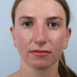 Rhinoplasty & Nasal Reconstruction Gallery | The Williams Center ...