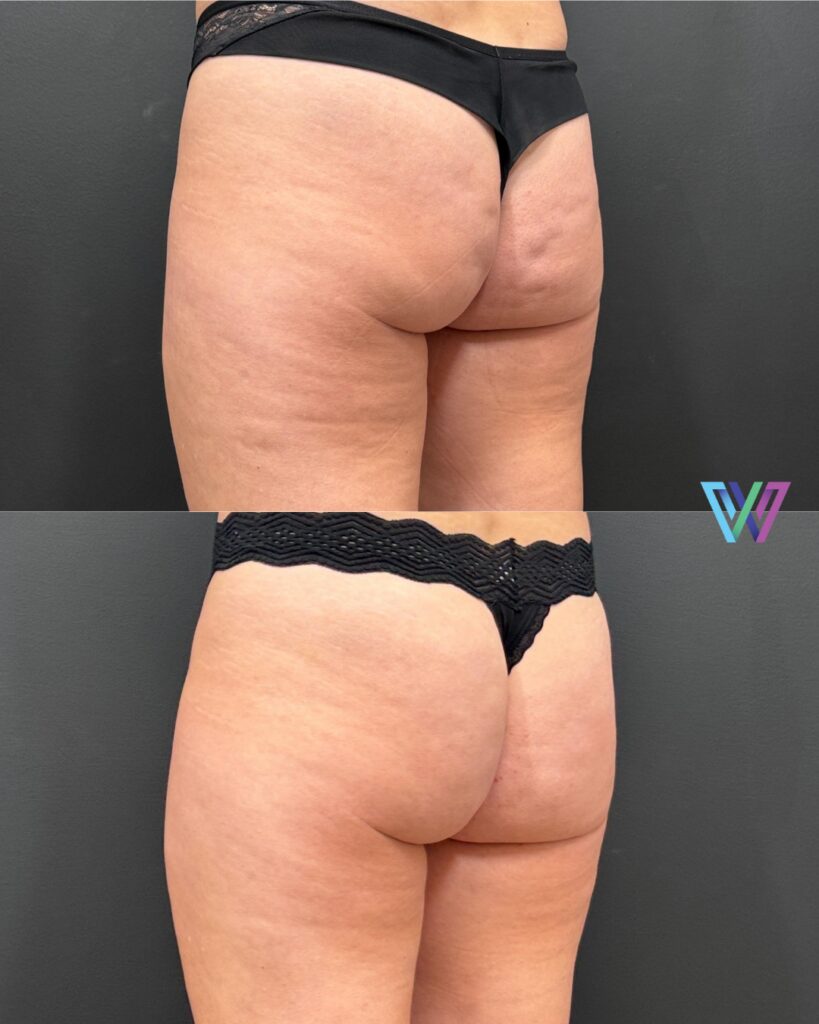 Cellulite treatment done by Dr. LLoreda at Williams center before and after photos