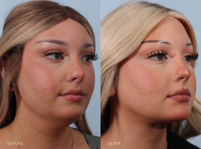 A side-by-side view of a woman's face before and after the Deep Neck Lift with Liposuction and Chin Augmentation procedure. The before photo shows a lack of crisp rejuvenation between her jawline and neck, contributing to a softer, less structured lower facial contour, with sub-mental fullness obscuring the sharpness of the mandibular border. The after photo shows a crisp, well-defined delineation between her jawline and neck, contributing to a structured, sculpted lower facial contour, with a smooth, flat sub-mental area enhancing the sharpness of the mandibular border. | Albany, Latham, Saratoga NY, Plastic Surgery