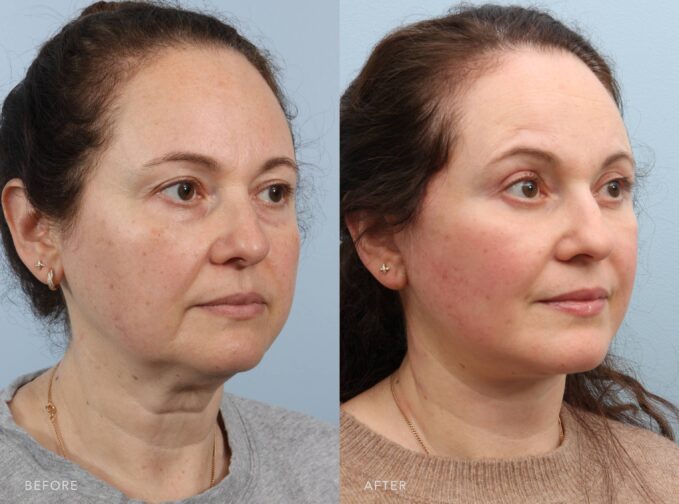 A side-by-side view of a woman's face before and after the Deep Plane Facelift, Upper and Lower Blepharoplasty, with Fat Grafting procedure. The before photo reveals overall signs of facial aging and slight dullness in skin tone. The midface and temples show a gentle loss of fullness, while gravity has caused descent in the cheek area. There’s visible puffiness around the eyes and a mild downturn at the corners of the mouth. The after photo shows smooth, glowing skin with fuller cheeks and temples. Her features look lifted and balanced, her eyes appear refreshed, and her expression is naturally bright and youthful. | Albany, Latham, Saratoga NY, Plastic Surgery