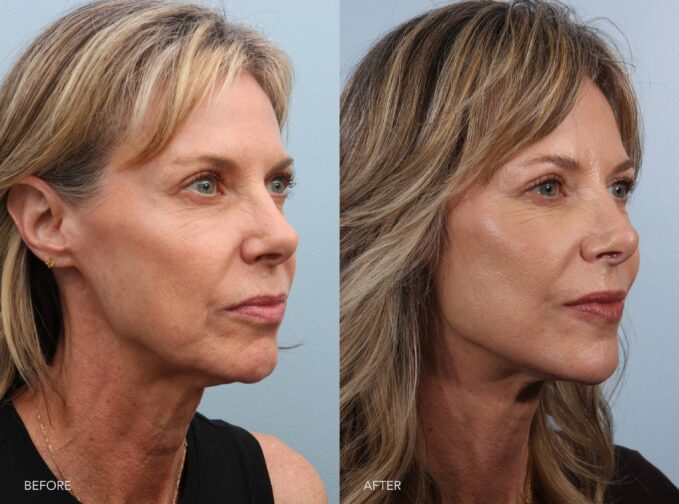 A side-by-side view of a woman's face before and after the Deep Plane Lower Face and Neck Lift procedure. The before photo shows skin laxity along the jawline, contributing to the development of jowls and reducing definition between the face and neck. The neck showed mild to moderate sagging, with less firmness and contour than desired. The after photo features a well-defined jawline and a more contoured neck, creating a smoother, youthful transition between the face and neckline. | Albany, Latham, Saratoga NY, Plastic Surgery