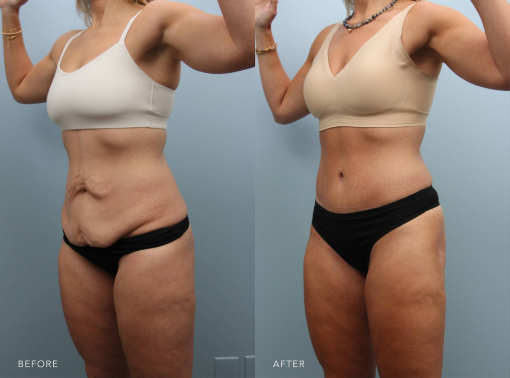 tummy tuck performed by Dr. Alfredo Lloreda at Williams center albany