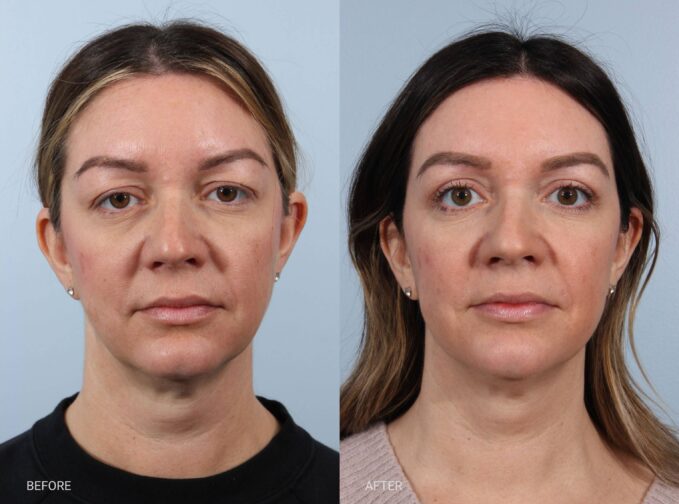 A photo of a woman’s face before and after the Sliver Blepharoplasty procedure. The before photo shows a mild to moderate skin redundancy on the upper eyelids that softens the natural crease and creates a heavier appearance over the eyes. This excess tissue slightly obscures the lid platform, giving the eyes a more tired and less defined look. The after photo shows smooth, well-contoured upper eyelids with a clearly defined natural crease. The eyelid skin appears firm and balanced, allowing the lid platform to remain visible and giving the eyes a brighter, more refreshed appearance. | Albany, Latham, Saratoga NY, Plastic Surgery