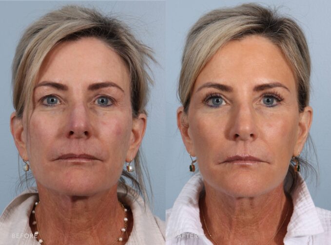 Before-and-after front-view photos of a woman who underwent Upper Blepharoplasty. The before image shows upper eyelid hooding and excess skin that contributes to a heavier appearance around the eyes. The after image reveals a more open eyelid contour, enhanced eyelid definition, and a brighter, more rejuvenated look. | Albany, Latham, Saratoga, NY, Plastic Surgery