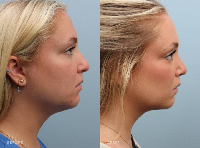 Before-and-after frontal photographs of a woman following completed functional rhinoplasty, presenting a comparison of her facial appearance before and after the procedure. The post-operative image shows a subtle change in the nasal contour and overall shape of the nose while maintaining the natural proportions of the face. | Albany, Latham, Saratoga NY, Plastic Surgery